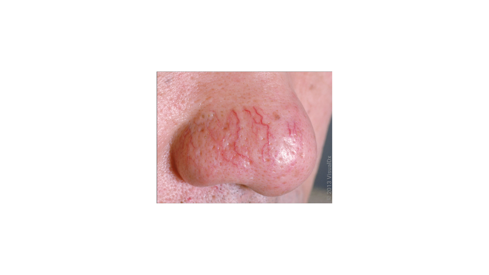 <h1>Facial Veins / <span style="color: rgb(21, 25, 33);">Telangiectasia</span></h1><p><br></p>